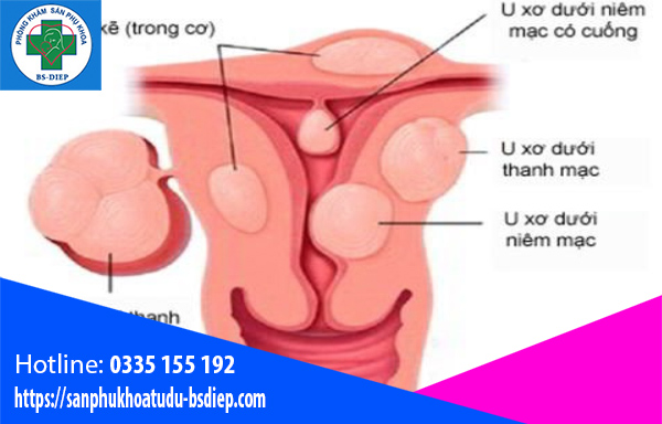 cac-loai-nhan-xo-tu-cung Nhân xơ tử cung