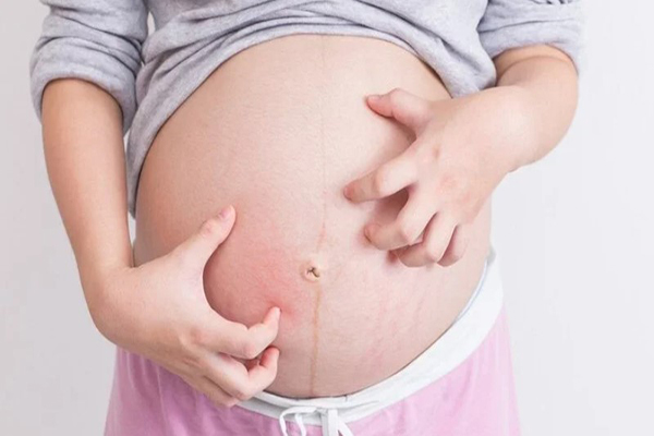 da-chuyen-vang Da chuyển vàng kèm theo các cơn ngứa ngáy dai dẳng là dấu hiệu nhận biết thai lưu điển hình trong tam cá nguyệt thứ ba