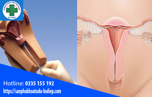 Dấu hiệu đặt vòng không hợp