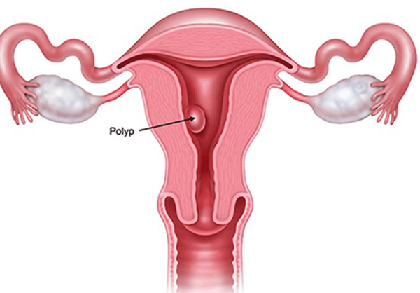 Dấu hiệu polyp cổ tử cung