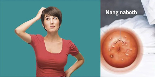 kieng-quan-he-khi-bi-nang-naboth Bạn cần kiêng quan hệ tình dục khi điều trị nang Naboth