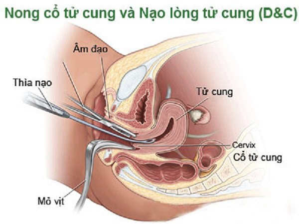nong-co-tu-cung Nong cổ tử cung