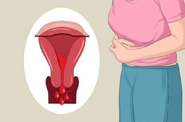 Rong kinh rong huyết có thể xuất hiện ở nhiều độ tuổi khác nhau