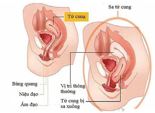 Sa sinh dục