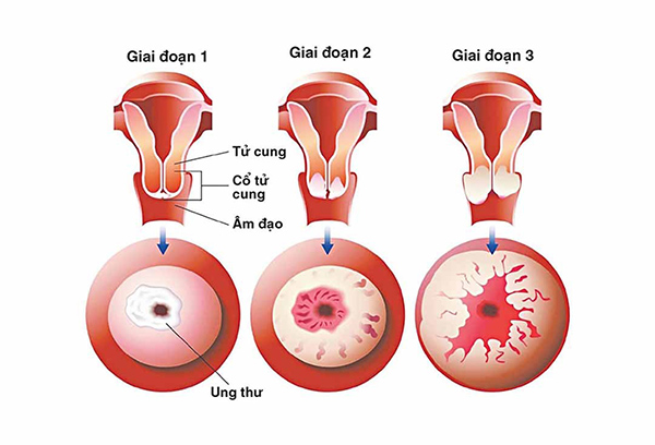 sang-loc-ung-thu-co-tu-cung Ung thư cổ tử cung