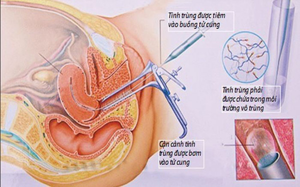Sau khi bơm tinh trùng có nên quan hệ