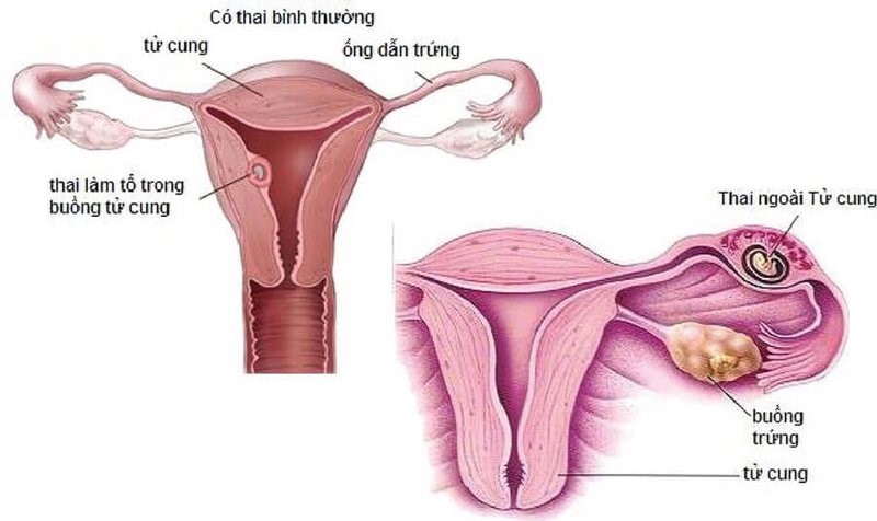 thai ngoài tử cung có giữ được kữ được không