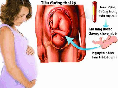 Tiểu đưởng thai kỳ