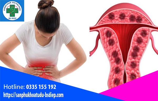 Triệu chứng lạc nội mc5 tử cung