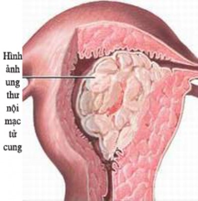 Các tế bào ung thư phát triển thành u ác tính